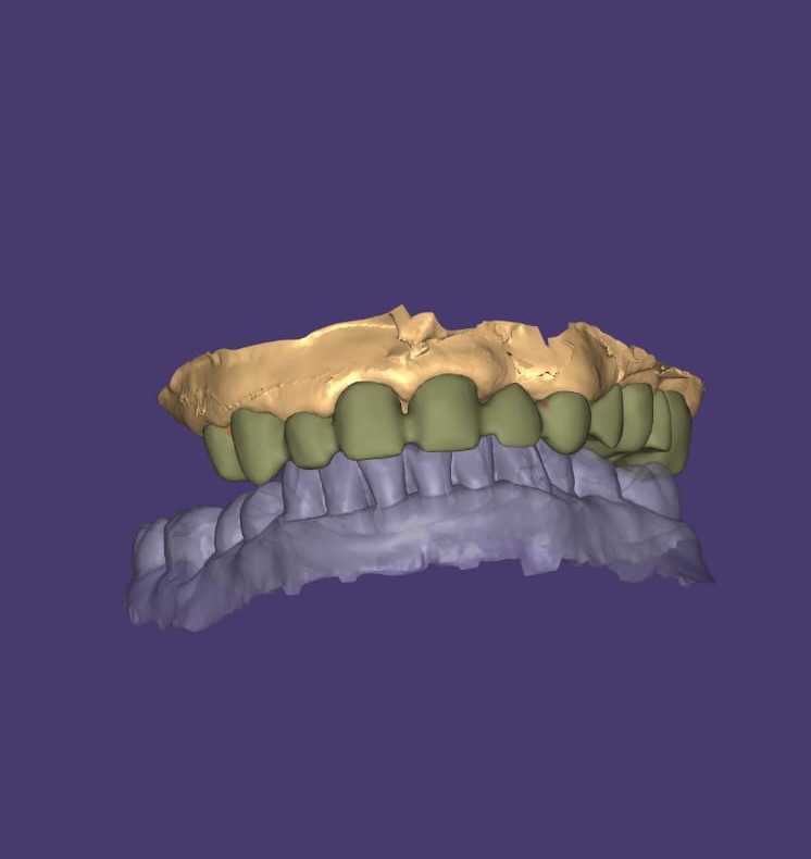Ceramic Dental Art prótesis dentales con impresión digital